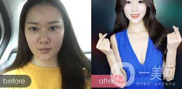 注射隆鼻整形多少要錢(qián)？微整形注射隆鼻過(guò)程
