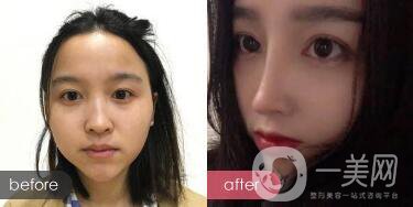 歪鼻整形痛嗎？歪鼻矯正圖片