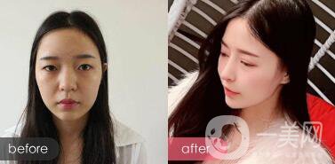 成都綜合隆鼻多少錢？綜合隆鼻真人案例
