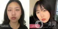 成都開眼角多少錢呢？開眼角案例