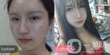 成都開眼角多少錢呢？開眼角案例