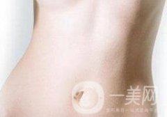 腹壁整形手術(shù)需要多少錢？