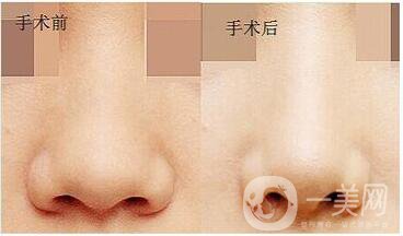 鼻子縮小