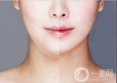 面部吸脂恢復(fù)多久？面罩戴多久？