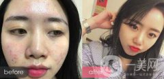 果酸祛痘*果嗎 果酸祛痘有什么好處？
