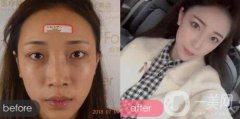 鼻翼整形：鼻翼縮小術(shù)后會留下疤痕嗎?