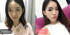 墊下巴前后圖：成都墊下巴整形攻略