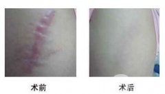 像素激光去疤痕有用嗎？術(shù)后護(hù)理三要點(diǎn)