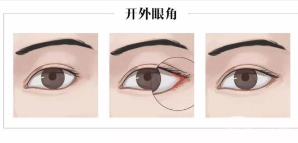開(kāi)外眼角前后圖片