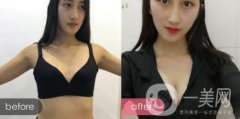 我適合做隆胸嗎 假體會(huì)放在什么位置 手術(shù)風(fēng)險(xiǎn)大不大？