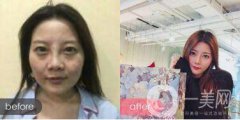 傳統(tǒng)激光皮膚療法和新型激光皮膚療法