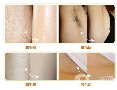 什么是激光脫毛？激光脫毛的優(yōu)勢有哪些？