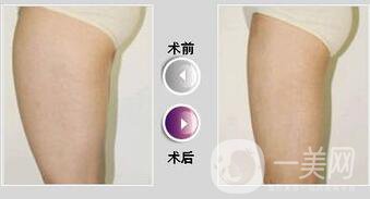 360度環(huán)形吸脂價格,360度環(huán)形吸脂*果