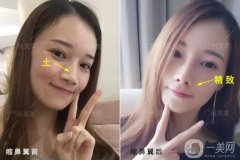 成都鼻翼縮窄多少錢？鼻翼縮小照
