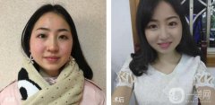 去頰脂墊瘦臉真人日記|還原清晰的臉部輪廓