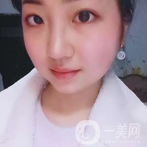去頰脂墊瘦臉、