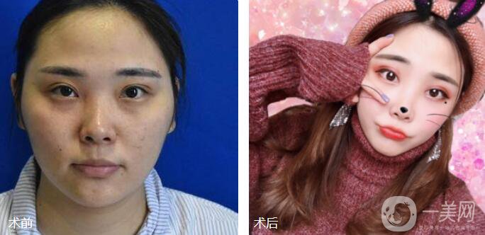 磨顴骨前后照片分享介紹 真人案例 33天就看見*果！