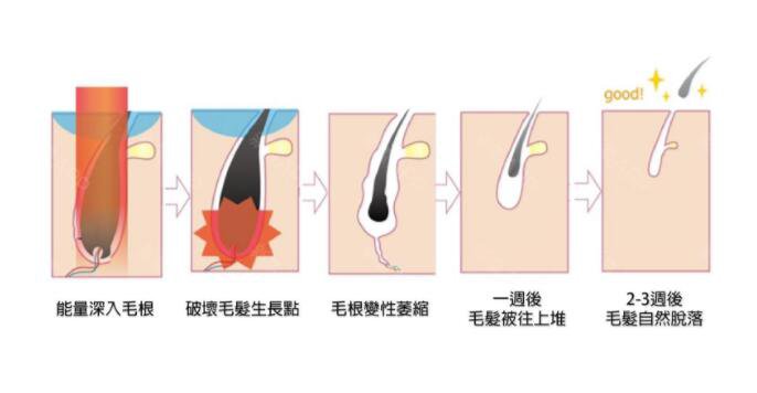 冰點華爾茲脫毛價格