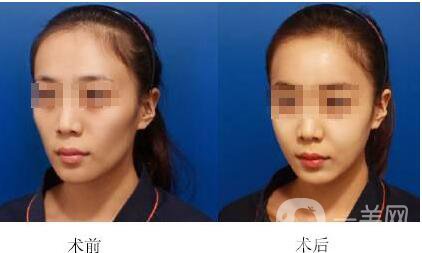 自體脂肪移植