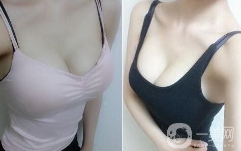 假體隆胸術有哪些特點？