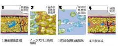 負(fù)壓吸脂果和水動(dòng)力一樣嗎?哪個(gè)更好?