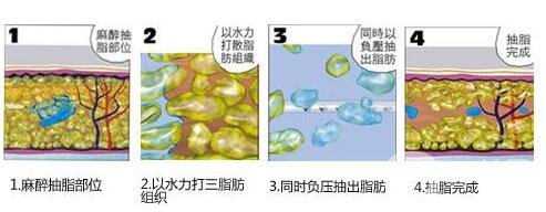 負(fù)壓吸脂*果和水動力一樣嗎?哪個更好?