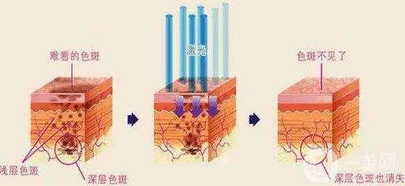 激光祛痘注意事項(xiàng)有哪些？