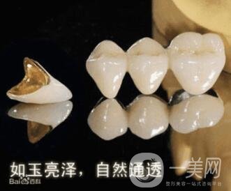 烤瓷牙的種類(lèi)和優(yōu)缺點(diǎn)分別是什么呢？