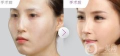 看了這些玻尿酸墊下巴后遺癥你還敢做嗎？