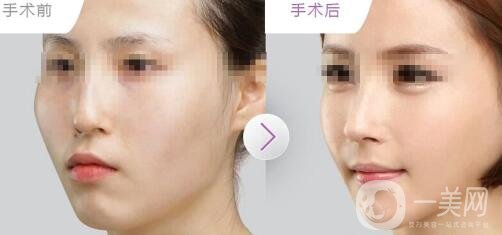 玻尿酸墊下巴