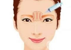 眉間紋打了玻尿酸多久才能恢復(fù)?