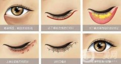 外切去眼袋會(huì)留疤嗎?多久可以恢復(fù)?