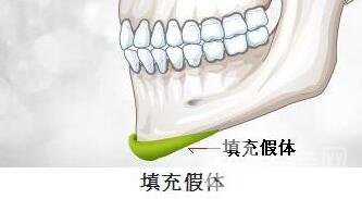 硅膠墊下巴要疼幾天？如何緩解這種疼痛感？
