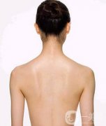 后背吸脂1000毫升多嗎？有明X的瘦背果嗎？