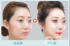 玻尿酸豐太陽(yáng)要幾支才夠？