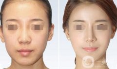 鼻翼縮小術(shù)費(fèi)用大概是多少？