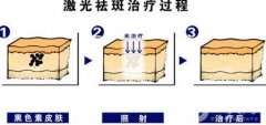 激光祛斑的優(yōu)勢(shì)有哪些?為什么這么多人去做?