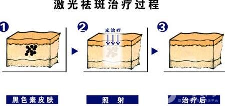 激光祛斑的優(yōu)勢(shì)有哪些?為什么這么多人去做?