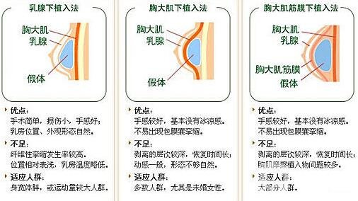 假體隆胸有哪些優(yōu)勢(shì)和缺點(diǎn)?為小白詳細(xì)解說