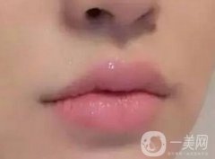 玻尿酸豐唇術(shù)手術(shù)費(fèi)用價(jià)格