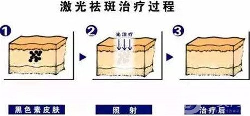 激光去雀斑會反彈嗎?術(shù)后注意事項有哪些?