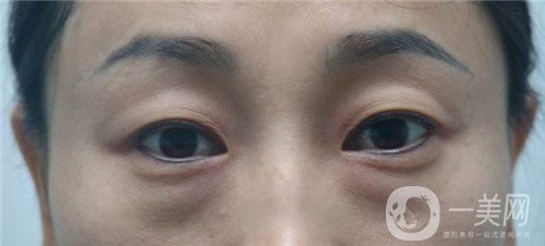 激光去眼袋的價(jià)格多少？要打幾次？