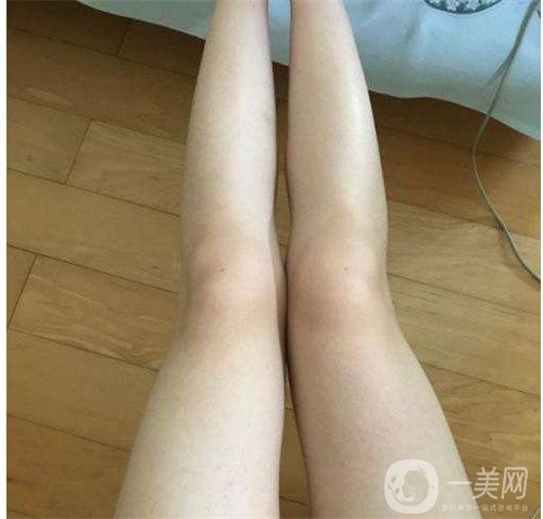 激光溶脂瘦大腿疼嗎？可以忍受嗎？