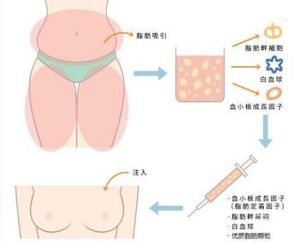 自體豐胸