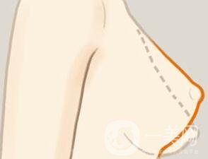 乳房下垂矯正后會反彈再次下垂嗎？術后穿什么內(nèi)衣？