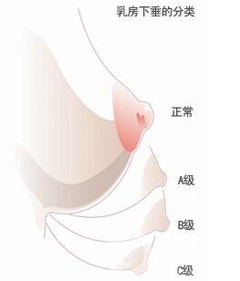 乳房下垂矯正后會反彈再次下垂嗎？術后穿什么內(nèi)衣？