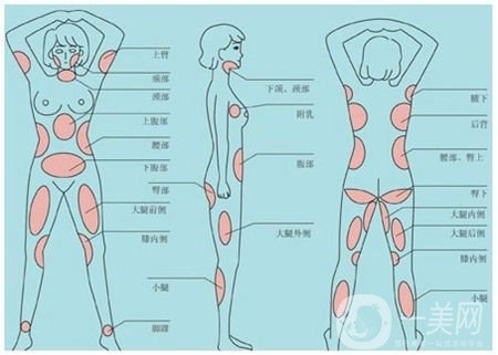 全身吸脂減肥危害大嗎？會(huì)不會(huì)死人？