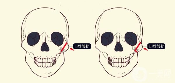 顴骨內(nèi)推和磨骨之間的區(qū)別是什么？哪個(gè)*果好些？