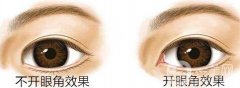 開眼角價(jià)位是多少?受哪些因素影響?