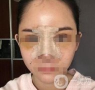 隆鼻固定膠帶幾天去掉？術(shù)后6天去掉會(huì)不會(huì)太早？